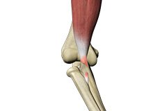 Biceps Tendon Rupture