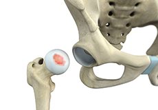 Chondral Lesions or Injuries