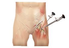 Hip Arthroscopy