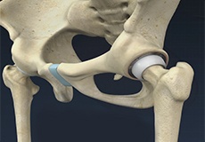 Hip Arthroscopy