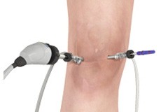 Knee Arthrosocpy