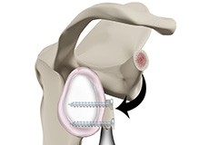 Latarjet Procedure