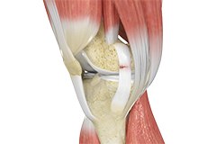 Arthroscopic Reconstruction of the Knee for Ligament Injuries