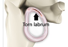 Shoulder Labrum Tear